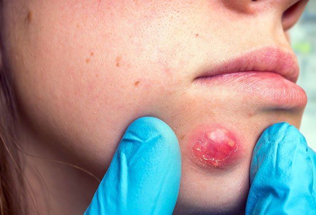 Pus is a thick fluid that builds up when an injury becomes infected. But pus isn't the only sign of an infection.