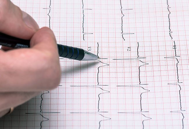 Untreated supraventricular tachycardia may cause life-threatening complications.