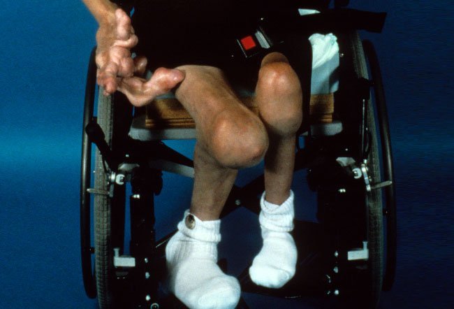 Proteus syndrome, also called elattoproteus syndrome or elephant man disease, is a rare genetic condition affecting about one in a million people in the world. Proteus syndrome cannot be cured. There are, however, several medical options to manage the signs and symptoms of the condition. 