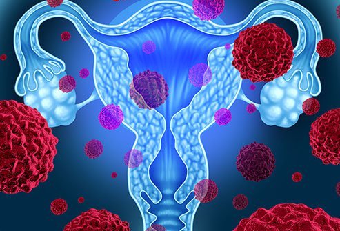 Uterus cancer has a more favorable prognosis when it's diagnosed and treated in the earliest stages. 