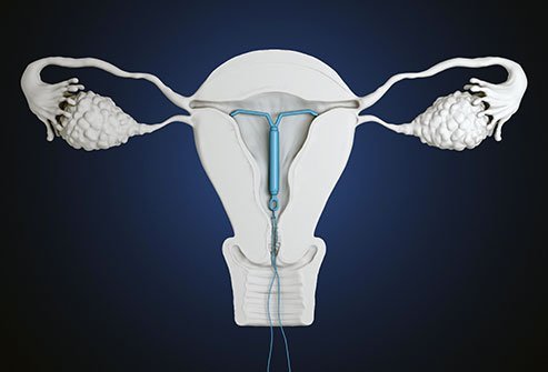 Getting pregnant while you have an IUD is extremely rare. There is one out of a hundred chances that this could happen. However, it has happened before.