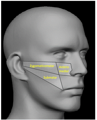 Mid-Face Regions Treated  - Illustration