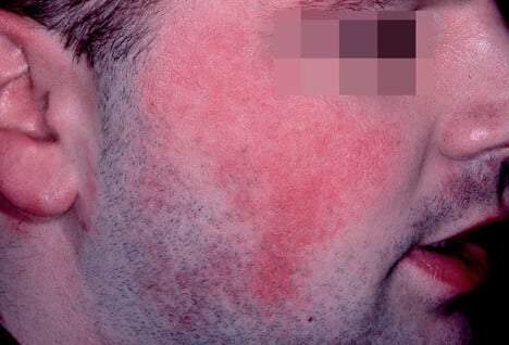 Picture of Keratosis Pilaris Atrophicans