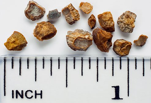 One of the best and easiest ways to prevent kidney stones is to drink plenty of water. 