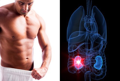 Hydronephrosis