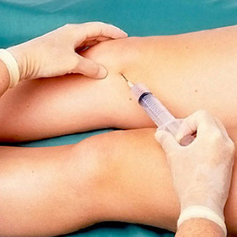 Fluid can be drained from an inflamed knee bursa to alleviate bursitis symptoms.