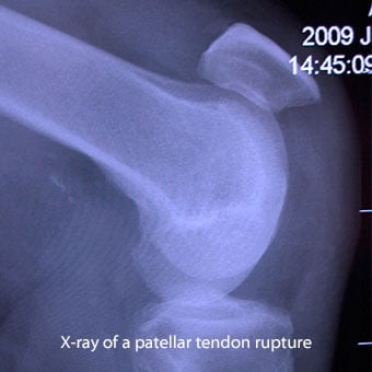 X-ray of a patellar tendon rupture.