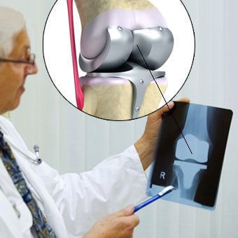 Model of a knee replacement with titanium hinge joint.