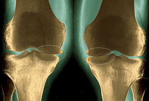 The cartilage that cushions the knee joint can wear away as you age.