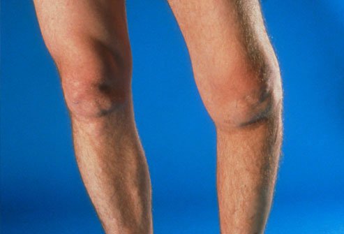 Knee replacement surgery may help you if other arthritis treatments do not work.
