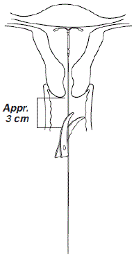 Removal of Kyleena - Illustration