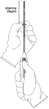 Advancing insertion tube until flange is 1.5
to 2 cm from the cervix - Illustration