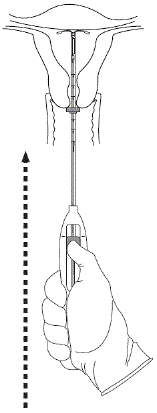 Move the slider all the way down to release
Kyleena from the insertion tube - Illustration