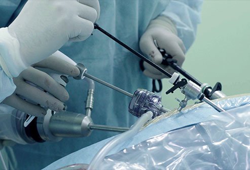 Laparoscopic inguinal hernia surgery