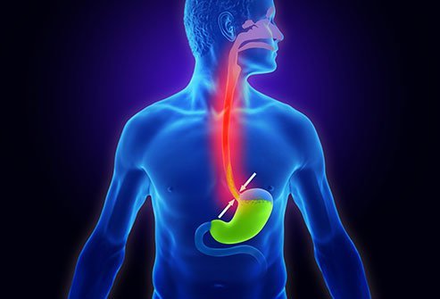 Laparoscopic Nissen fundoplication is a surgical procedure to strengthen the esophageal muscle and cure severe GERD.