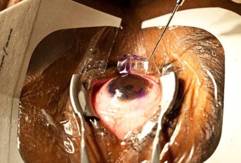 LASIK is the name for the most commonly performed refractive laser procedure.