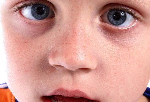 Genetics can play a role in causing lazy eyes. If there's a family history of amblyopia (lazy eye), you should consult an eye doctor by the time your child is two years of age.