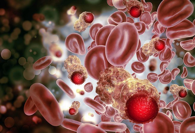 Leiomyosarcoma (LMS) is a malignant tumor that originates in smooth muscle cells. Leiomyosarcoma (LMS) is not hereditary, which means it does not run in families. However, LMS can be part of many genetic syndromes that can be inherited. 