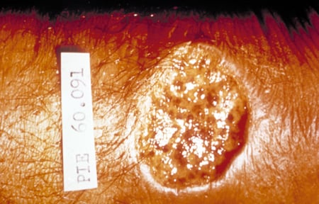 Picture of a crater lesion of leishmaniasis, skin.