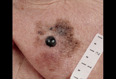 Picture of Lentigo Maligna Melanoma