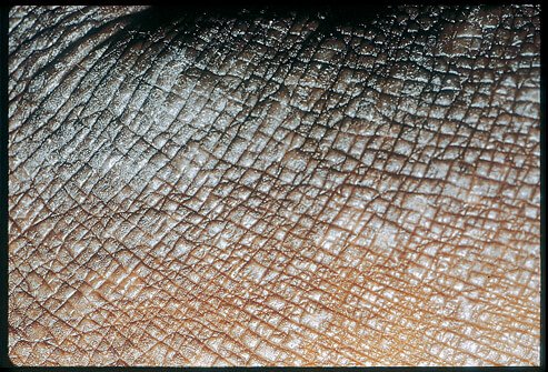 Picture of Lichen Simplex Chronicus