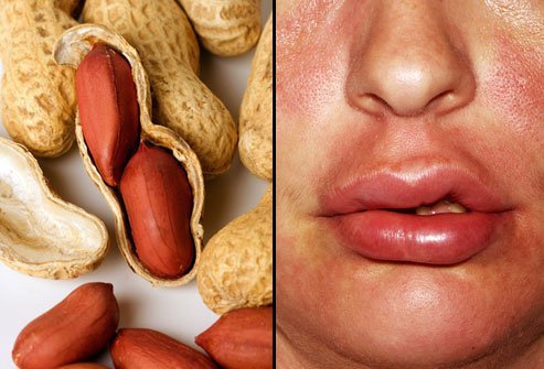 Peanuts are one of the most common food allergies.