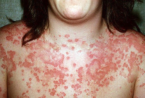 Call 911 and get medical help right away at the first sign of anaphylaxis.