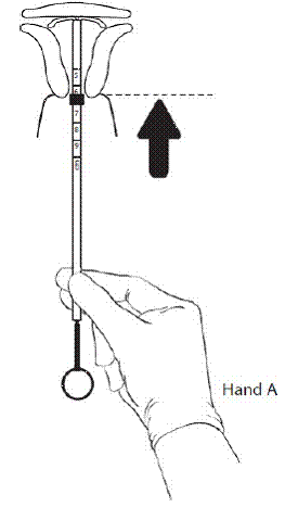 advance to the fundus - Illustration