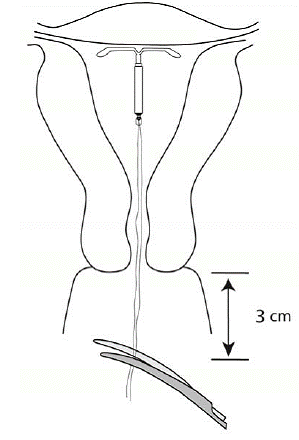 Cut the threads about 3 cm from the cervix - Illustration