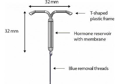 LILETTA Intrauterine Contraceptive System (IUS) - Illustration