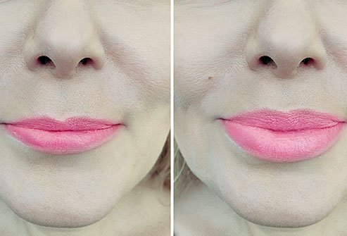 Lip implants are structures designed to fit in the lips to achieve a semi-permanent or permanent effect.