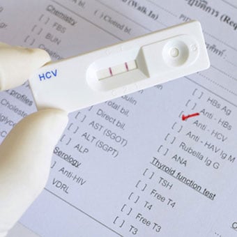 Hepatitis C virus (HCV) test cassette shows positive reading (double red band).