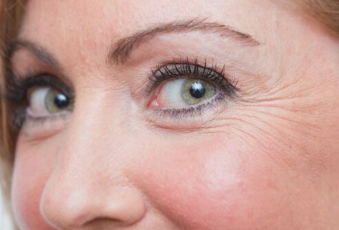 Alpha-hydroxy acids improve the appearance of crow's feet.