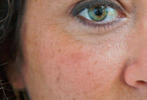 You can fade age spots with creams containing hydroquinone.