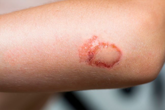 Sexual activity can cause carpet burns and scrapes. Carpet burns can be very painful, but they'll heal on their own in a few days.