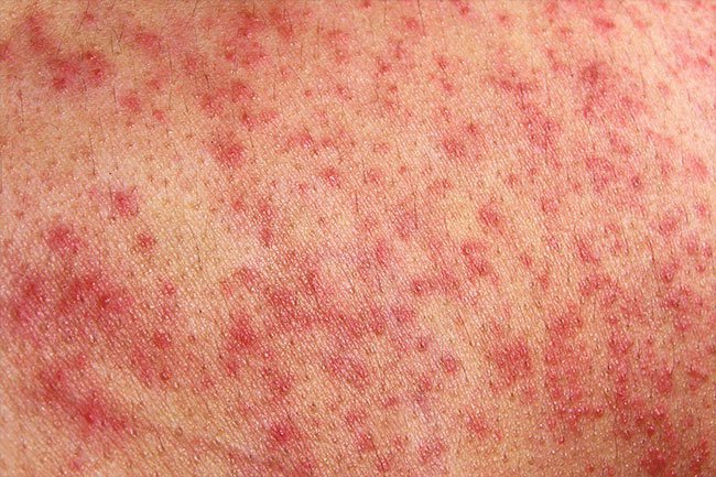 Lubricant, spermicides, condoms, and other items can all trigger allergic reactions during sexual activity.