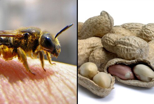 Some people have a severe, potentially life-threatening, allergic reaction (anaphylaxis) to peanuts, IV contrast dye, bee stings, antibiotics, or other foods and substances.