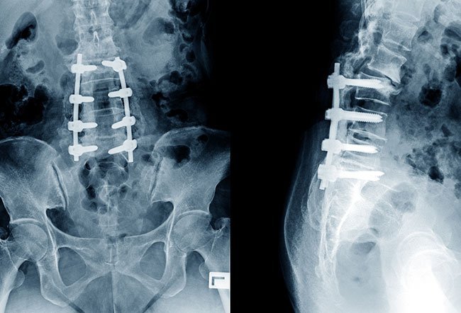 A minimally invasive surgical procedure, the spinal fusion is used to treat lumbar (lower back) pain if the pain hasn't resolved on its own after six to 12 weeks. A spinal fusion operation causes the vertebrae (bones of the spine) in the lower back to grow together, reduce pressure on the nerves, and reduce pain.