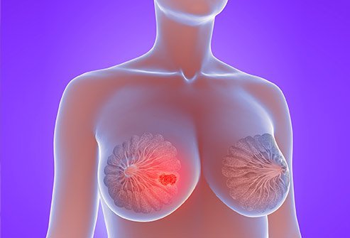 Lumpectomy is performed under anesthesia; hence, the procedure itself is not painful.