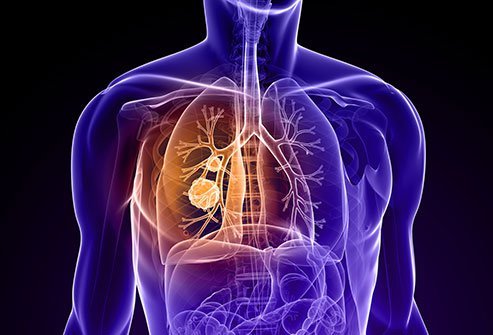 Lung cancer, also known as lung carcinoma, is defined as an uncontrolled growth of tumor cells in the lungs.