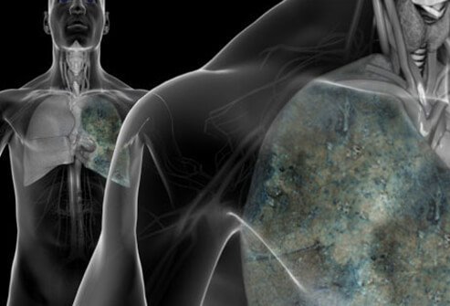 Lung cancer has emerged as the leading killer of men and women stricken with invasive cancer, affecting husbands and wives, friends and neighbors, and causing suffering for many families.