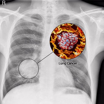 Lung cancer X-ray with callout showing close-up of tumor.