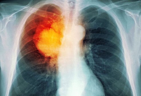 If the screening tests suggest a person has lung cancer, definitive diagnostic tests may be done by a pathologist.