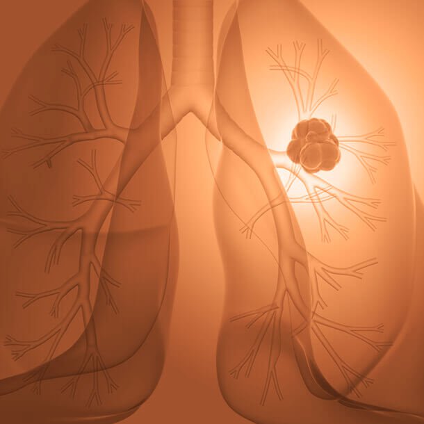 A bronchoscopy uses a viewing tube to evaluate a patient's lung and airways to treat or diagnose lung conditions.