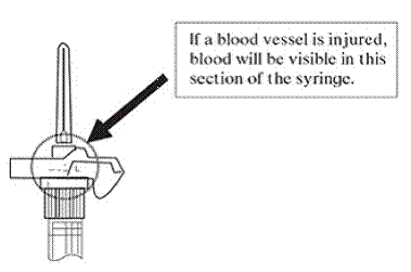 If a blood vessel is accidentally penetrated,
aspirated blood will be visible just below the luer lock - Illustration