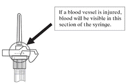 LuproLoc® safety device - Illustration