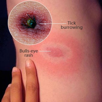 A tick bites and burrows into the skin (left); the reddish bull's-eye rash (right) typically appears days to weeks later.