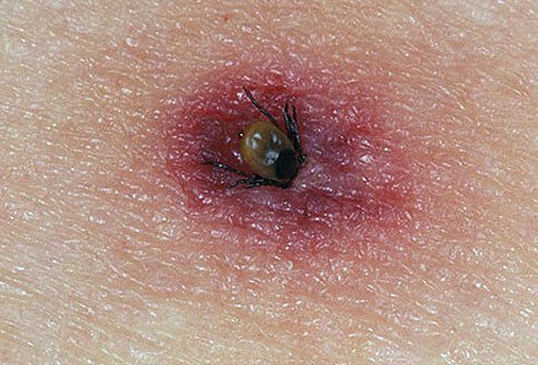 Some ticks carried by deer transmit the bacteria that cause Lyme disease.
