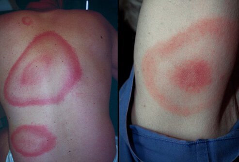 A characteristic flat, red ring or bull's-eye rash develops in 75% of those who have been bitten by a tick infected with Lyme disease.