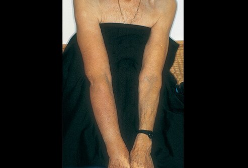 Picture of Lymphedema